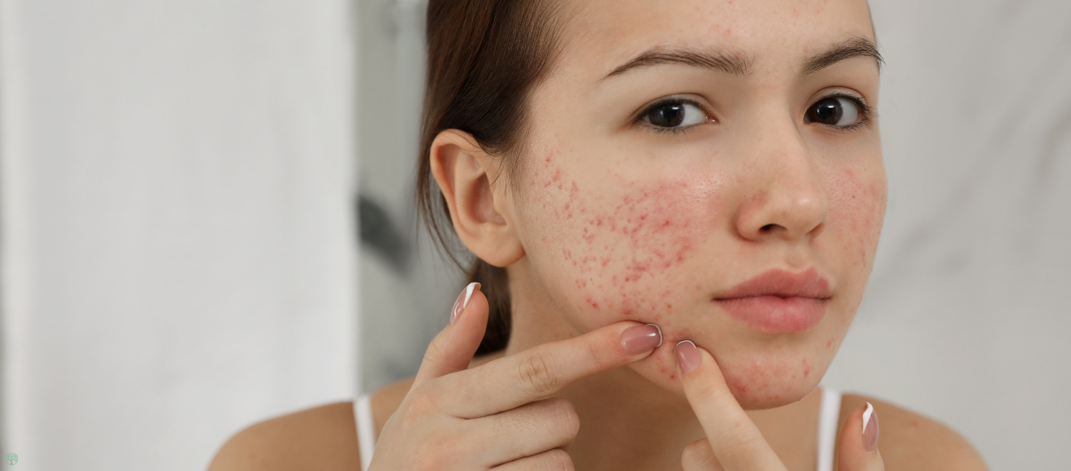 Gezicht jonge vrouw met acne, tips bij acne